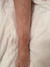 After varicose treatment